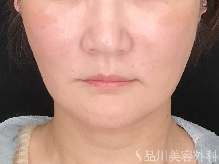 症例NO.64780のBEFORE写真