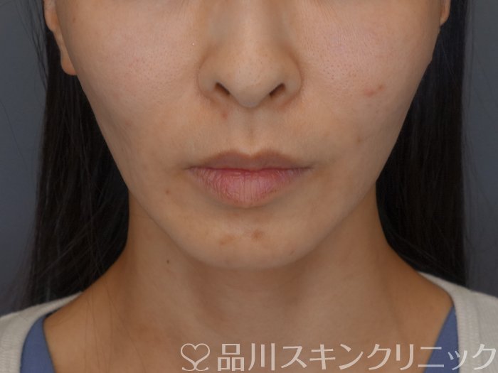症例NO.71717のAFTER写真