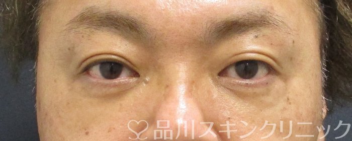 症例NO.65090のAFTER写真