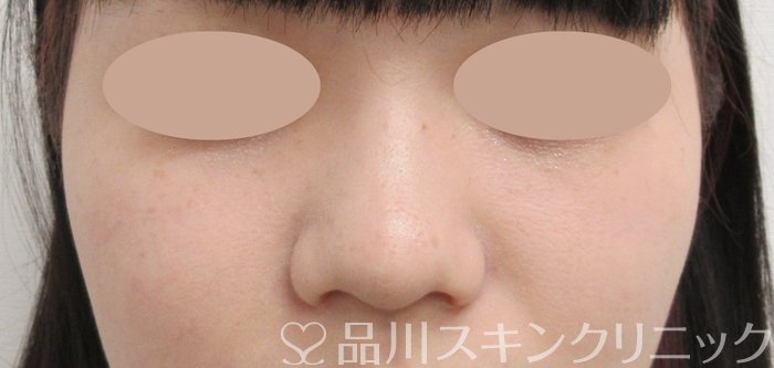 症例NO.65598のAFTER写真