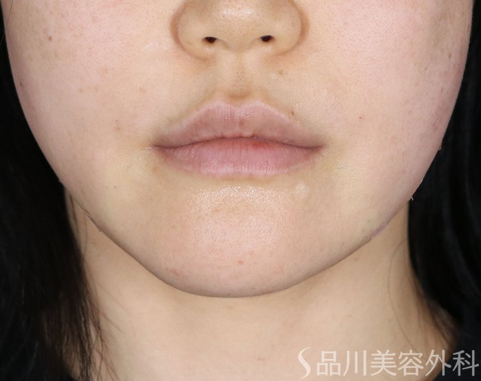 症例NO.74031のAFTER写真