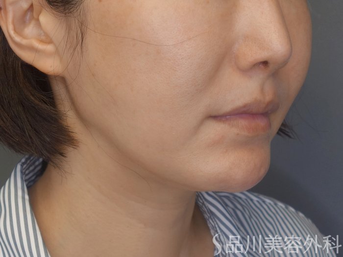 症例NO.71990のBEFORE写真