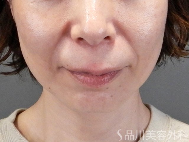 症例NO.69682のBEFORE写真