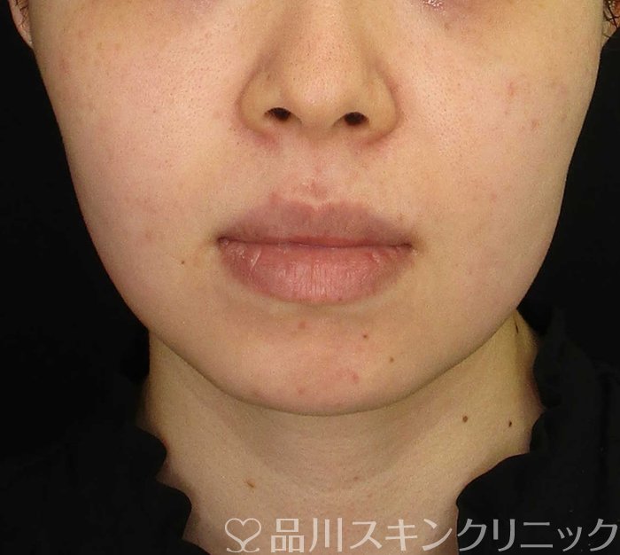 症例NO.70448のAFTER写真