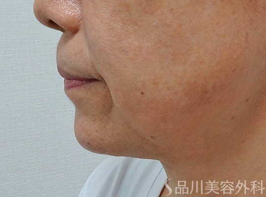 症例NO.73520のAFTER写真