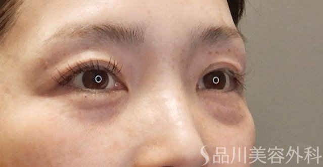 症例NO.74745のBEFORE写真
