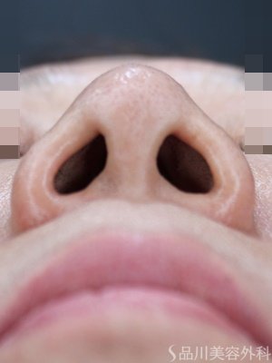 症例NO.74727のBEFORE写真
