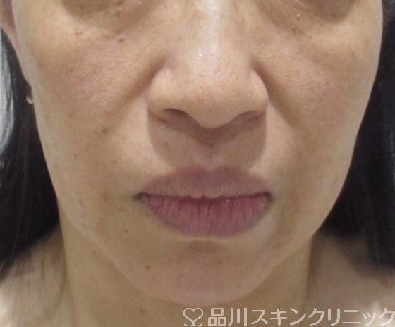 症例NO.38247のAFTER写真