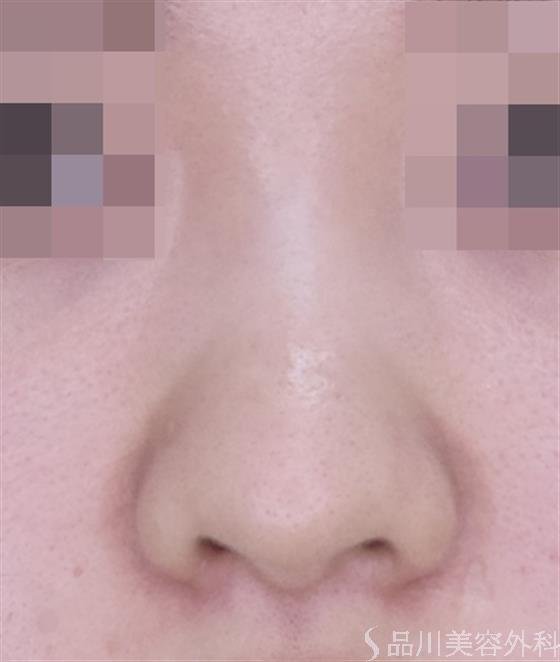 症例NO.49319のBEFORE写真