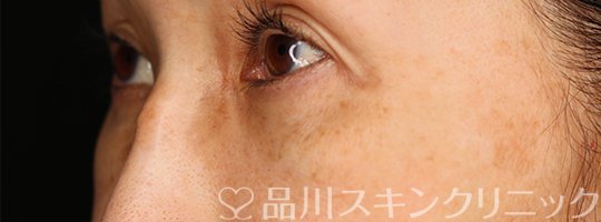 症例NO.69831のAFTER写真