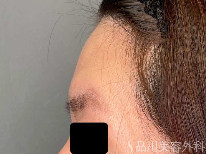 症例NO.65449のBEFORE写真