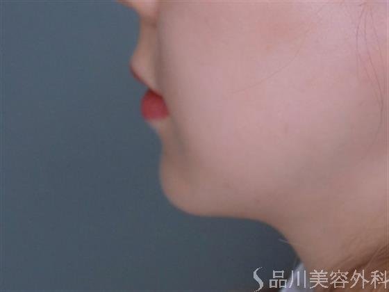 症例NO.51248のBEFORE写真