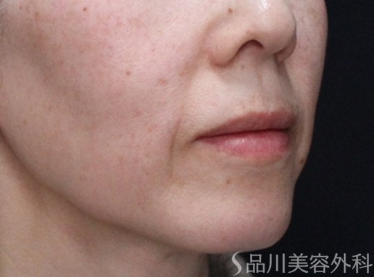 症例NO.72469のBEFORE写真