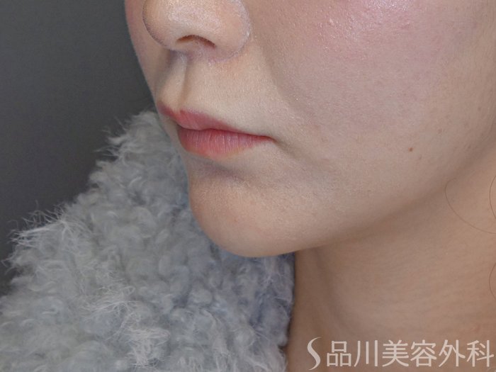 症例NO.72406のAFTER写真