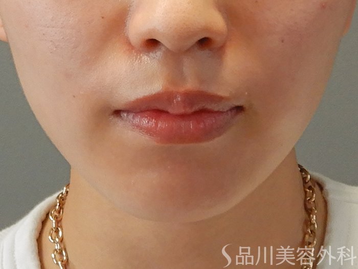 症例NO.70567のBEFORE写真