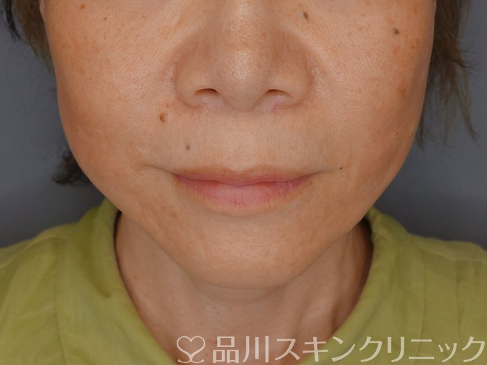 症例NO.71260のAFTER写真