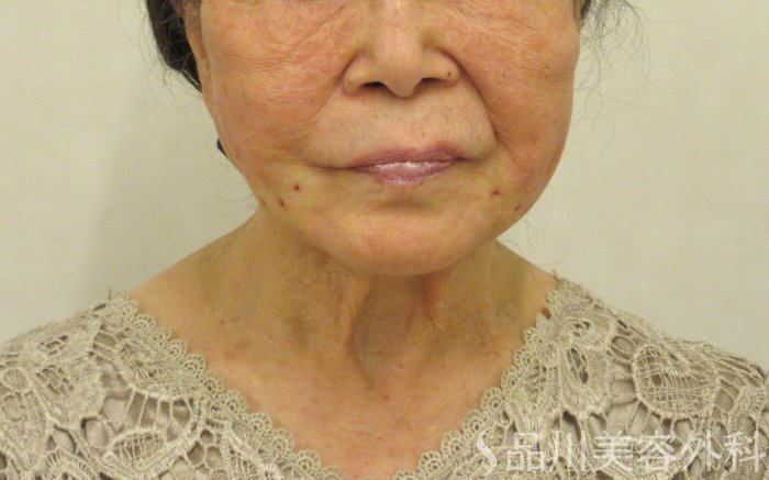 症例NO.72613のAFTER写真