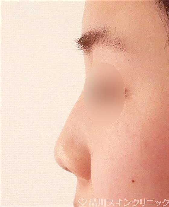 症例NO.57659のBEFORE写真