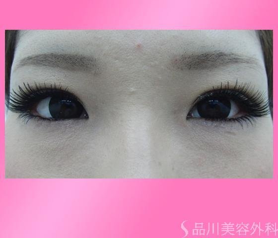 症例NO.3494のAFTER写真