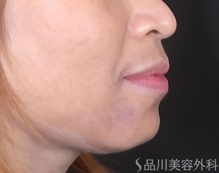 症例NO.69609のBEFORE写真