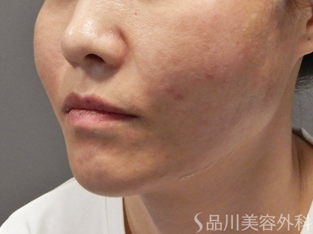 症例NO.71830のAFTER写真