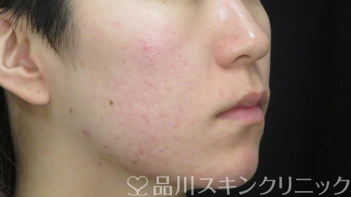 症例NO.71515のBEFORE写真