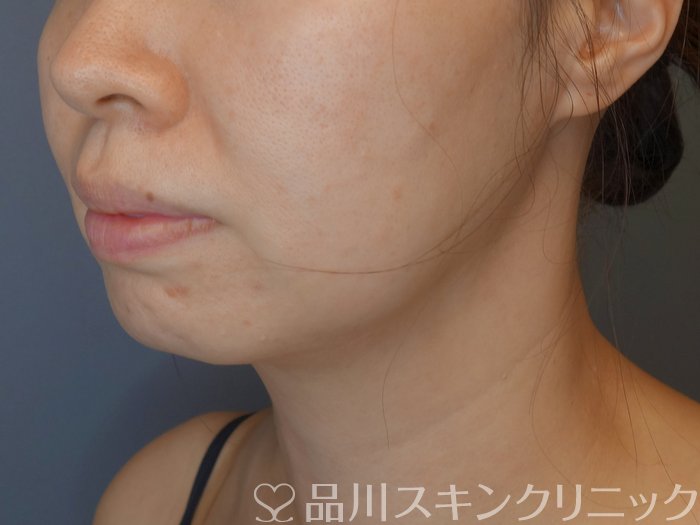 症例NO.71881のBEFORE写真