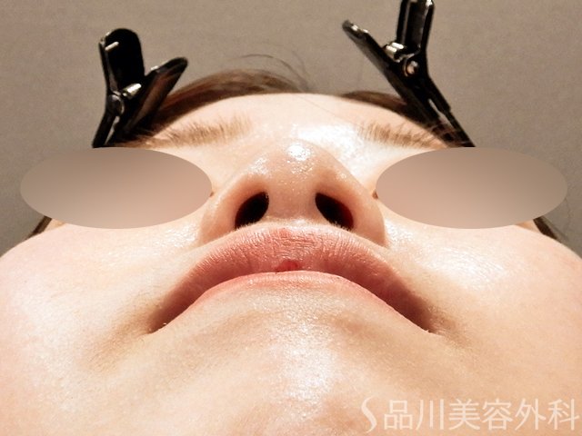 症例NO.69518のAFTER写真