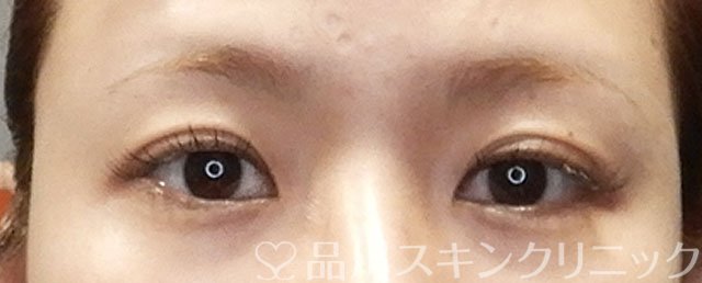 症例NO.72991のBEFORE写真