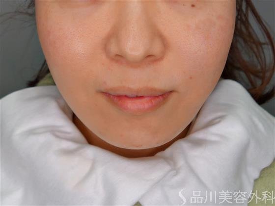 症例NO.55049のAFTER写真