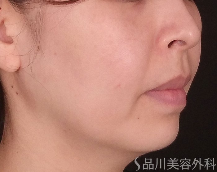 症例NO.69794のBEFORE写真