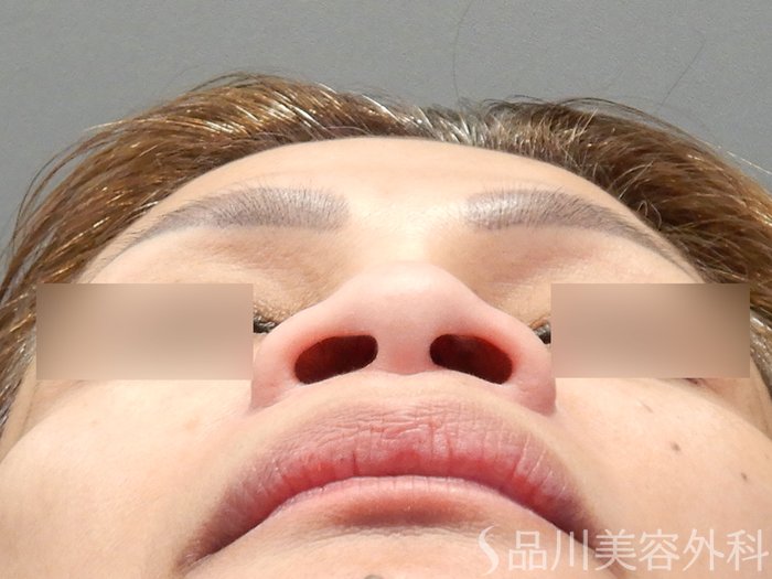 症例NO.74188のBEFORE写真