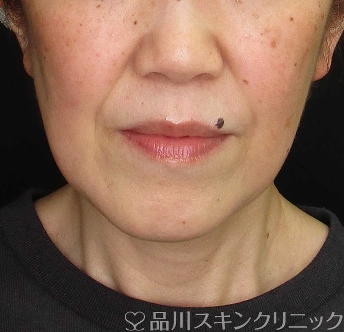 症例NO.69789のBEFORE写真