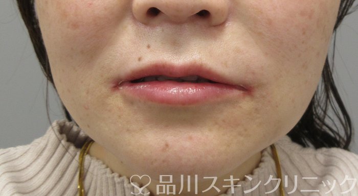 症例NO.74110のAFTER写真