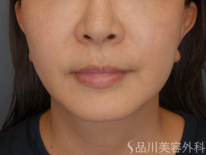 症例NO.71940のBEFORE写真