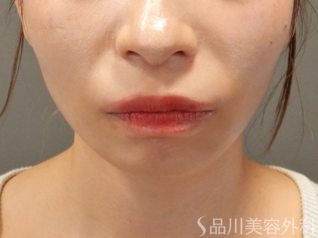 症例NO.71674のBEFORE写真