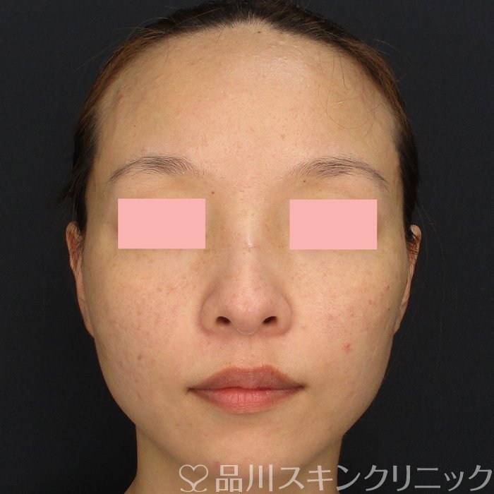 症例NO.71417のAFTER写真