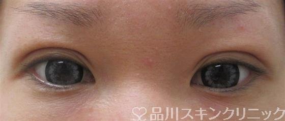 症例NO.27014のAFTER写真