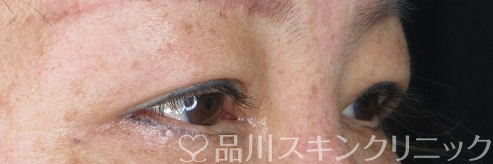 症例NO.65678のAFTER写真