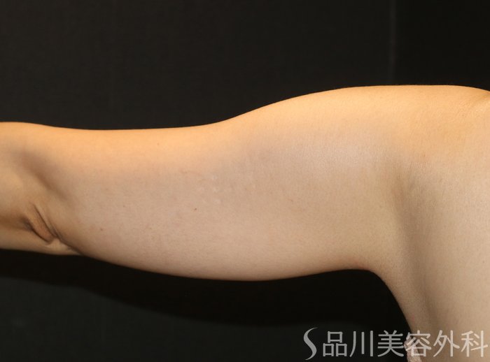症例NO.71568のBEFORE写真