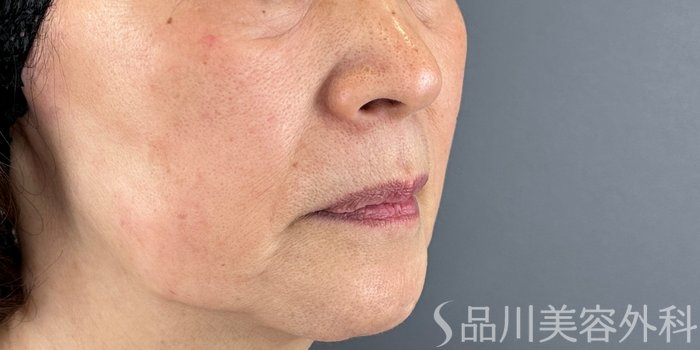 症例NO.72447のBEFORE写真