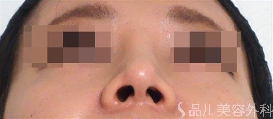 症例NO.35704のAFTER写真