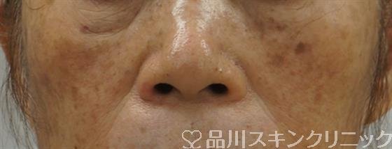 症例NO.51716のAFTER写真