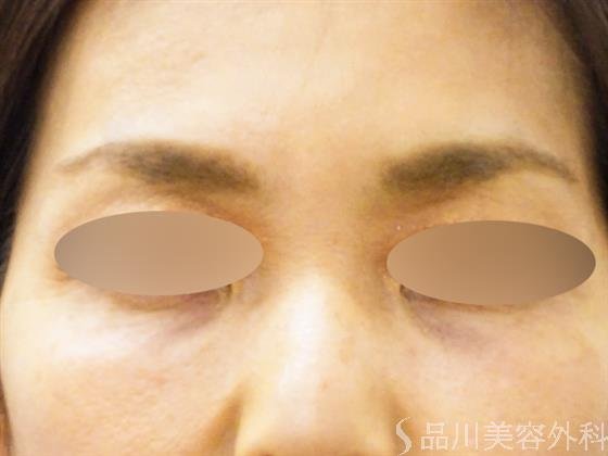 症例NO.51420のBEFORE写真