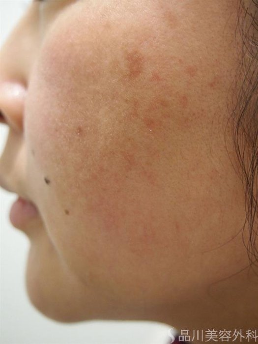 症例NO.22000のBEFORE写真