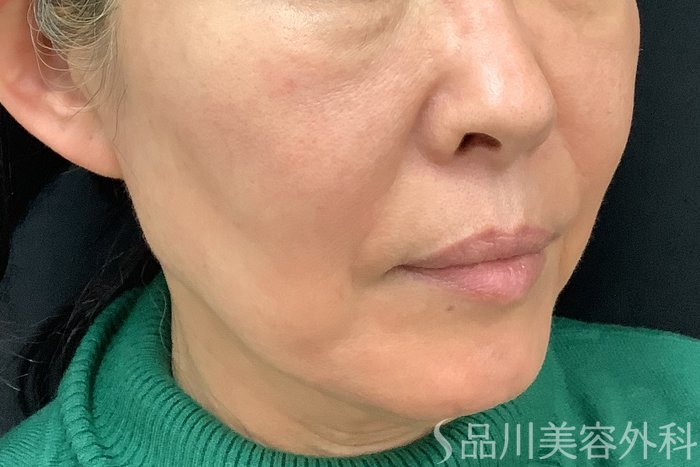 症例NO.71233のBEFORE写真