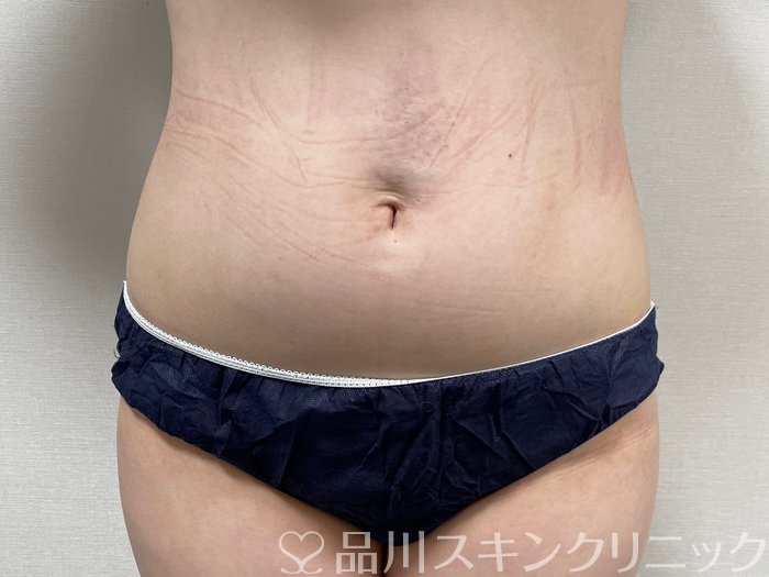 症例NO.74485のBEFORE写真