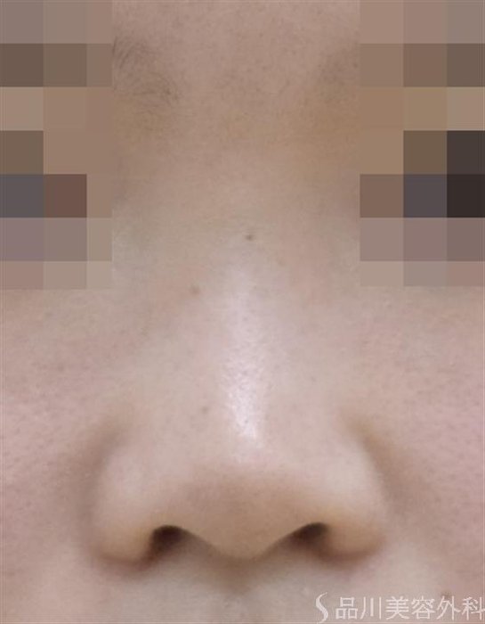 症例NO.50691のBEFORE写真