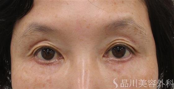 症例NO.57477のAFTER写真