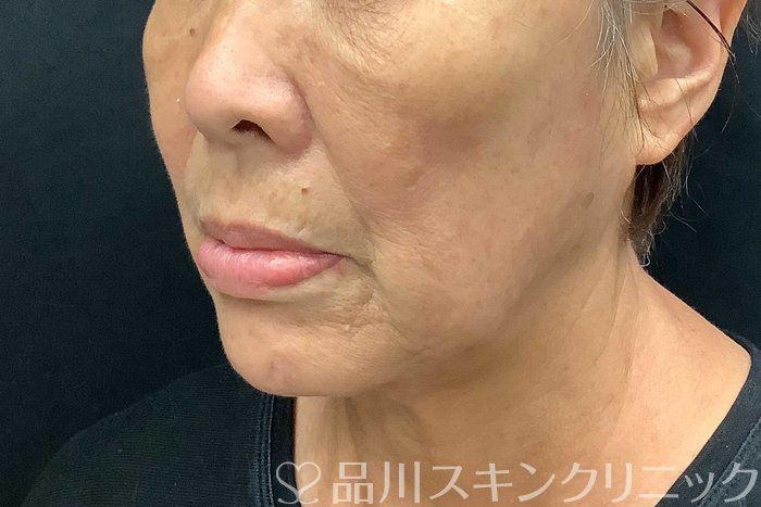 症例NO.69776のBEFORE写真